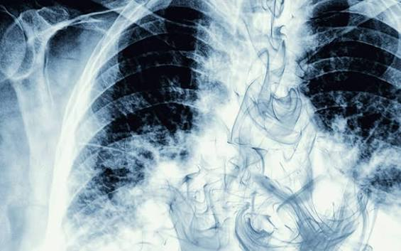 Chest X-ray showing lung damage and opacity overlaid with swirling toxic smoke clouds - Vaping vs Smoking health impact guide by VapeFeat